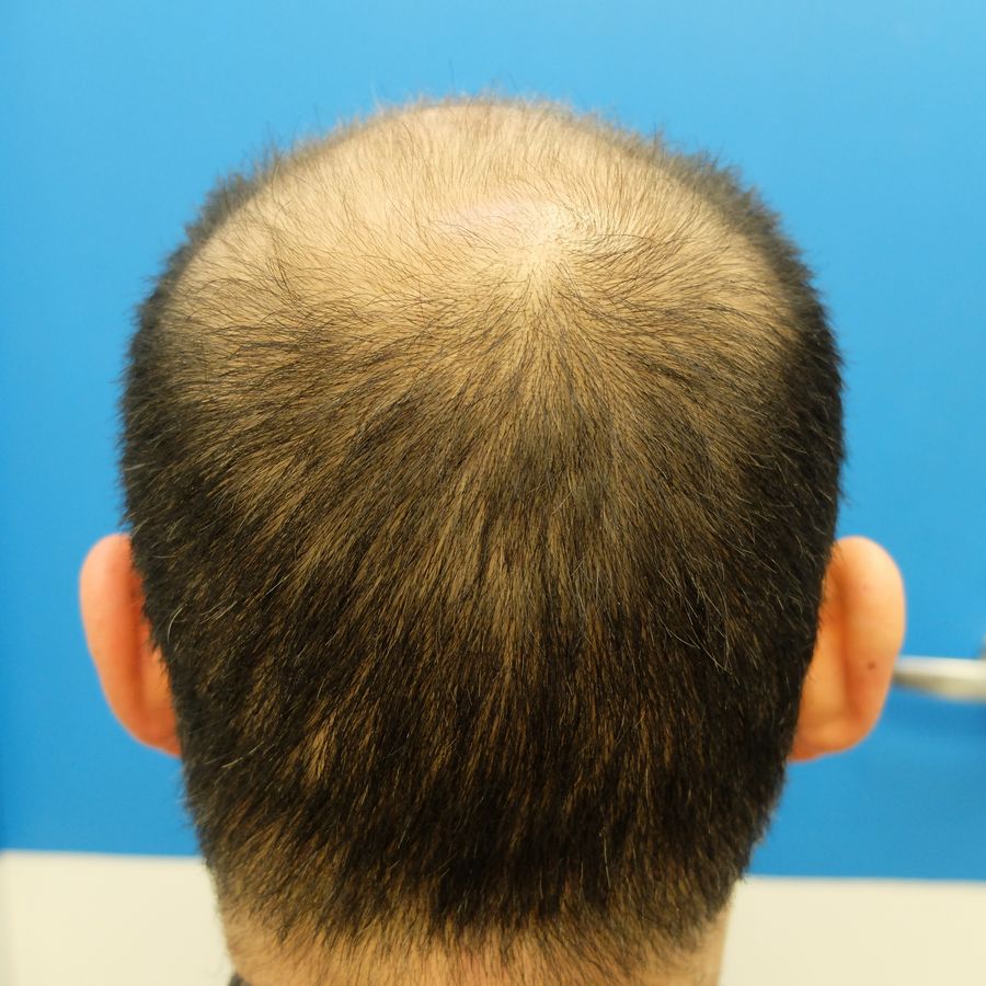 FINASTERIDE-GEL-2.5-RESULT-AFTER-2-MONTHS-1.jpg