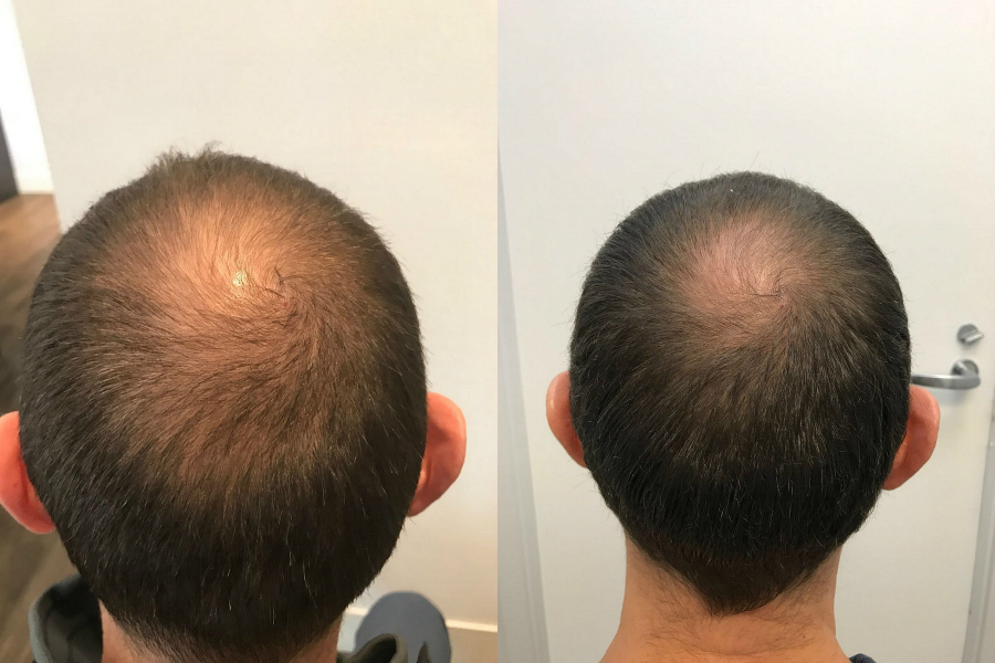 FINASTERIDE GEL 2.5-RESULT_zpsfoigghig.jpg