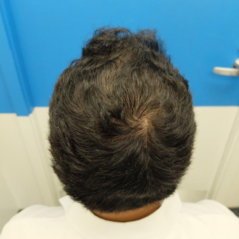 finasteride-gel-result-1-year.jpg