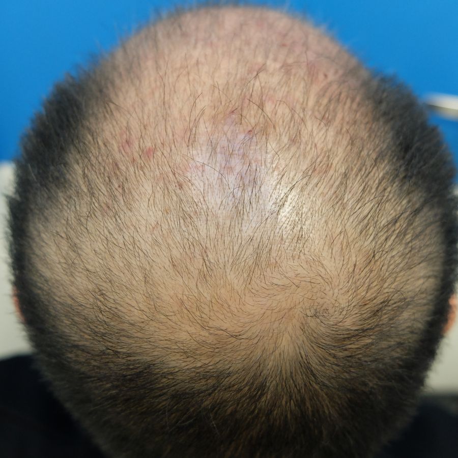 FINASTERIDE-GEL-RESULT-AFTER-2-MONTHS-1.jpg
