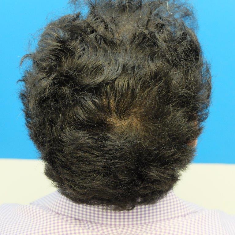 finasteride-gel-results-2-years.jpg