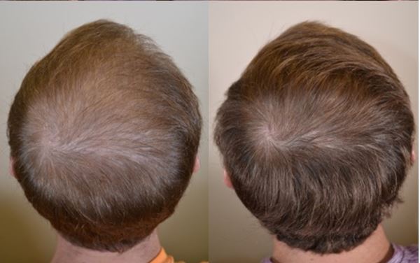 FinasterrideResult25yearOld2-1.jpg