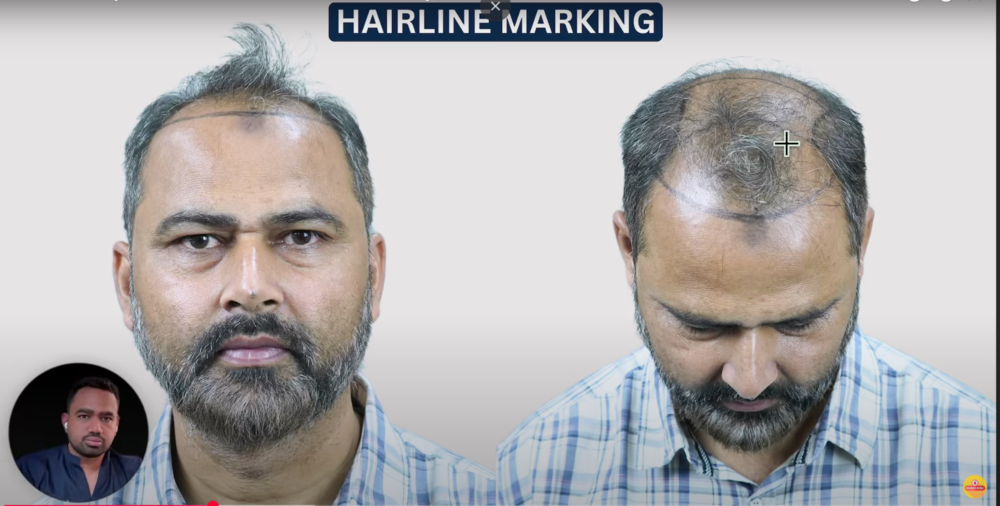 hairline marking.png