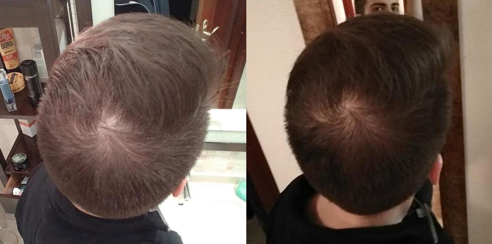 hairloss.jpg