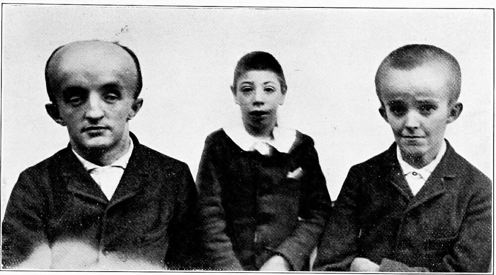 Hydrocephalus_AB,_Microcephalus_B.jpg