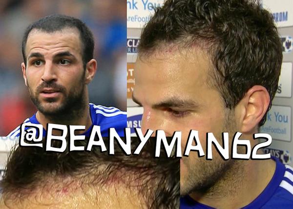 image-http-3a-2f-2fwww-101greatgoals-com-2fwp-content-2fuploads-2f2014-2f10-2fhairtransplant-jpg.jpg