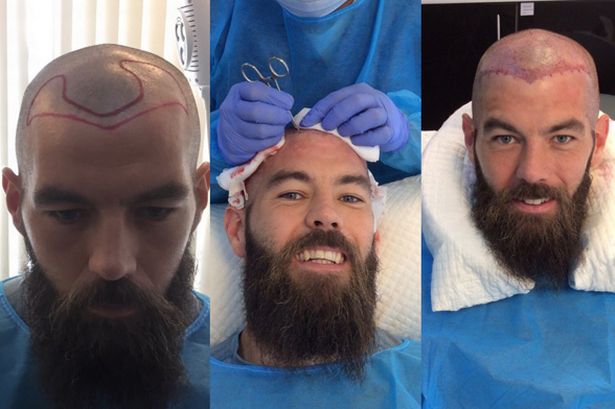 Joe-Ledley-hair-transplant.jpg