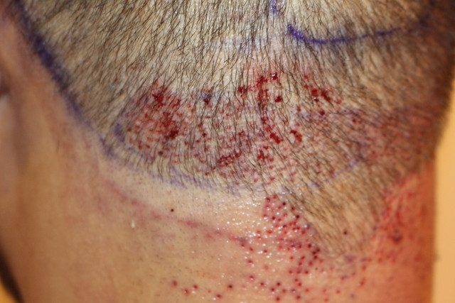 Left-Post-Op.jpg