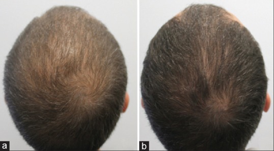 Mesotherapy_Dutasteride.jpg