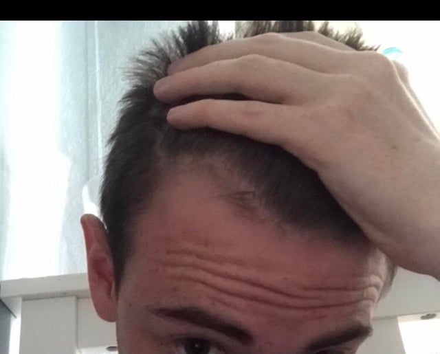 mewing-works-for-hair-loss-aswell-v0-5pyhg2q15j5a1.jpg