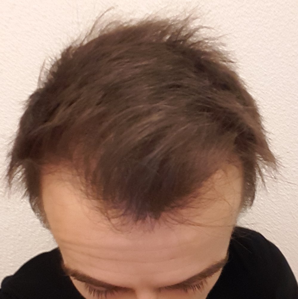 minoxidil 1 an.jpg