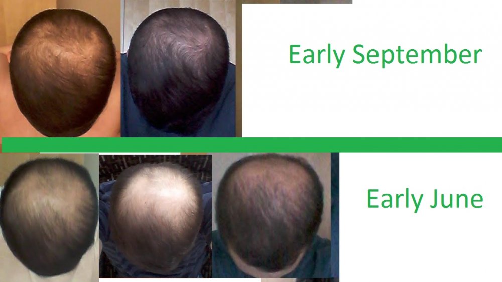 minoxidil.jpg