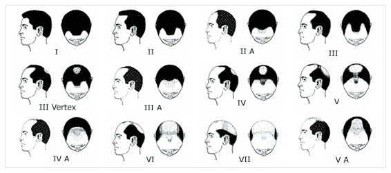 norwood-hamilton-scale.png