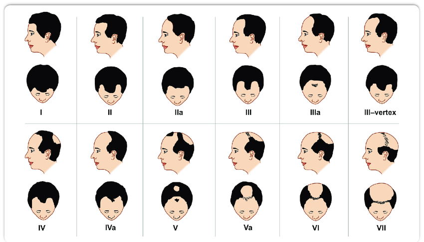 Norwood-Hamilton-scale-The-following-categories-are-defined-as-follows-Type-I-no.png