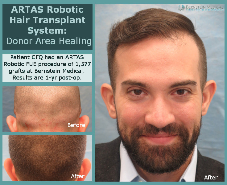 Patient%20cfq%20-%20ARTAS%20Donor%20Area%20Healing.jpg