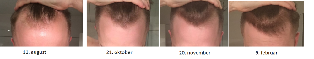 progresjon 6 mnd minoxidil.png
