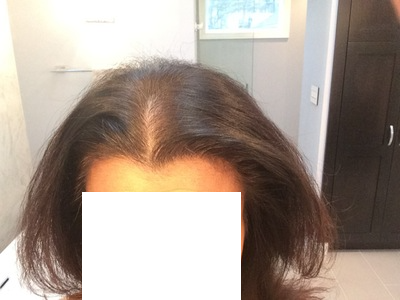 prp before.png