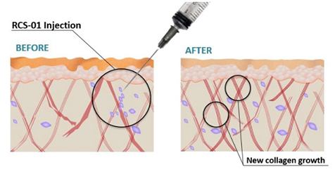rcs-01-injection.jpg