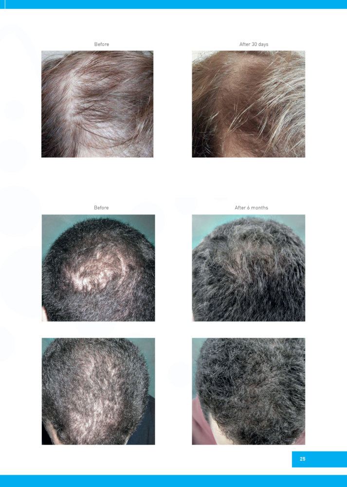 Regenera-Activa-before-after-4.jpg
