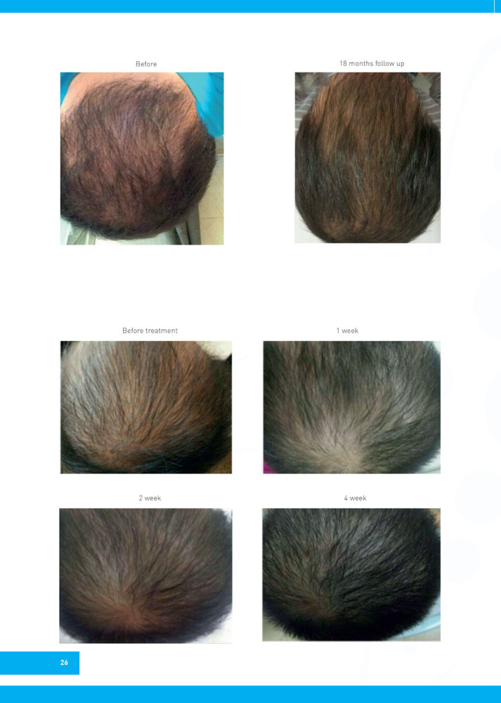 Regenera-Activa-before-after-5.jpg