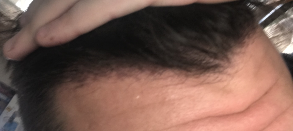 Right_TP3_2weeks.png