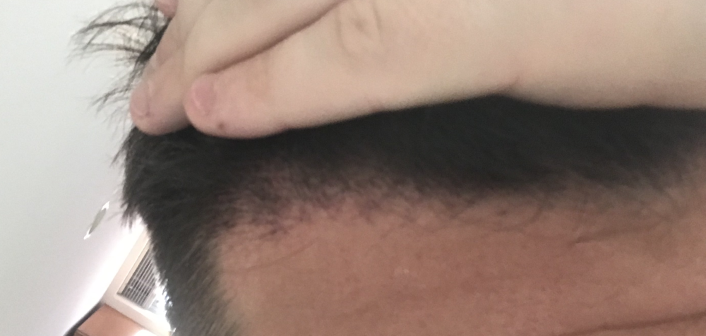 Right_TP3_2weeks_b.png
