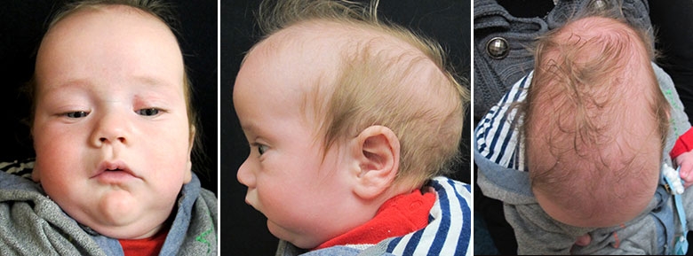 sagittal-synostosis-image1.jpg