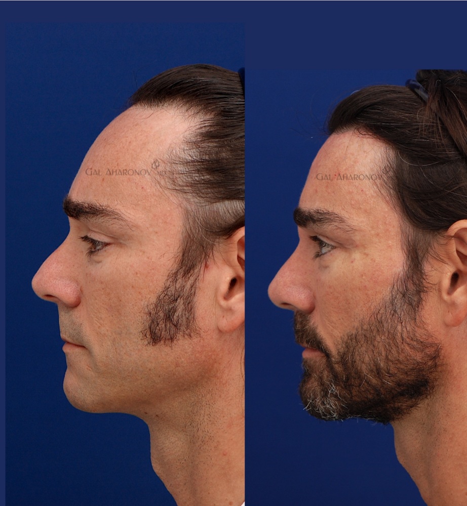 scalp_advancement_forehead_reduction_hairline_lowering_04.jpg