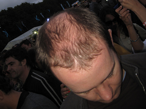 Smoking-and-Hair-Loss.png