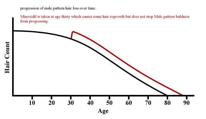 stooping-hair-loss-with-minoxidil.jpg