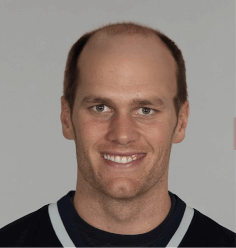 Tom-Bradys-Hair-Loss-min-2-1.png