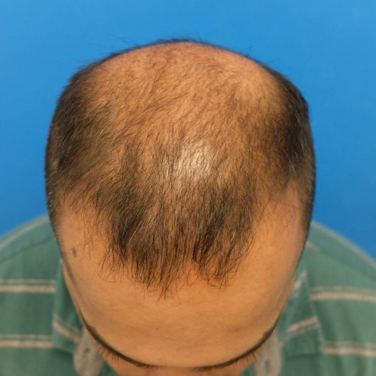 topical-finasteride-before.jpg