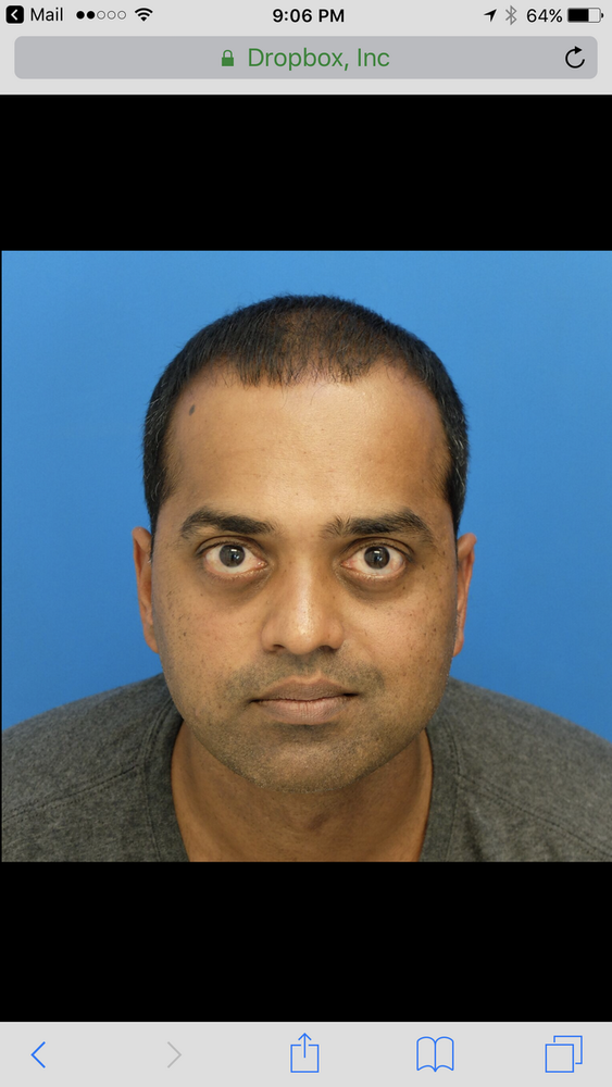 topical-finasteride-results-after-9-months.png