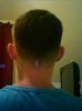 alopecia.jpg