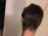 Alopecia After.jpg