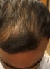 Shortly before transplant, dry hair.jpg
