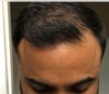 Shortly before transplant, dry hair2.jpg