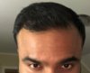 Shortly before transplant, dry hair in low light.jpg