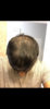 12 months after transplant, dry hair.jpg
