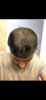 12 months after transplant, dry hair2.jpg