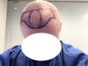 Day 1.2 - Hairline.JPG Day 1.2 - Hairline.JPG