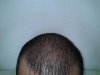 3186 Graft 10 Post Op.jpg