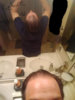 before finasteride.jpg