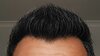 Hairline 6 Month.jpg