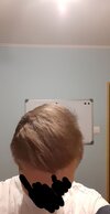 hairloss 2.jpg