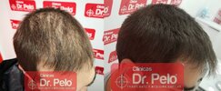 tratamiento-capilar-dr-pelo-sevilla-badajoz-madrid-cordoba-valladolid-albacete-merida_22-1.jpg