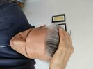 longer term minoxidil.jpg