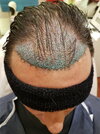 day 1 of surgery - front.jpg