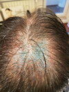 day 2 of surgery - top.jpg