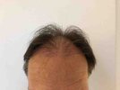 2 months after - front.jpg